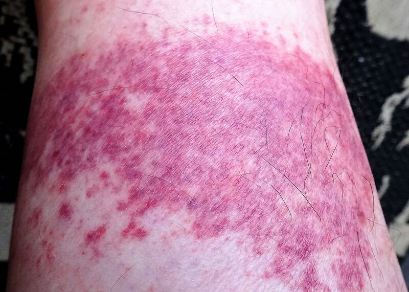 File:Cutaneous vasculitis, ankle area.jpg
