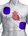 Cardiopulmonary resuscitation