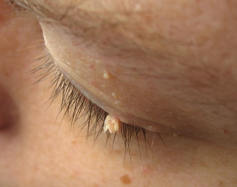 File:Wart filiform eyelid.jpg