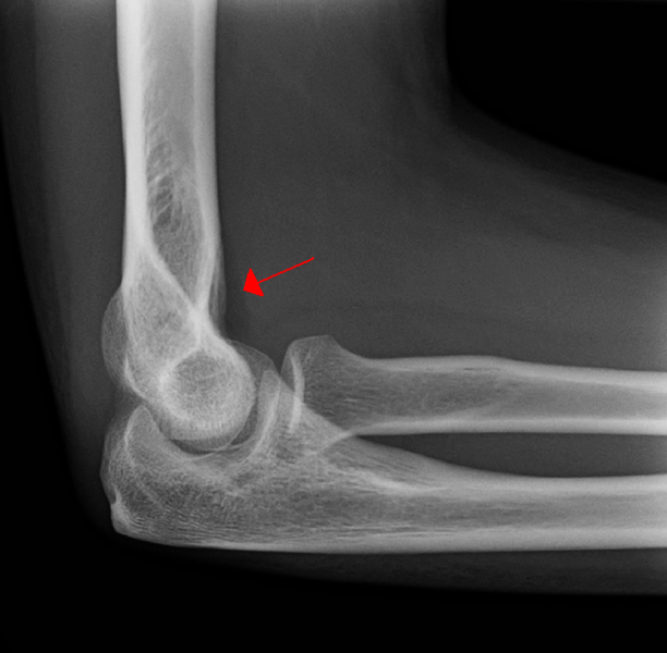 File:AnteriorFatPad.PNG