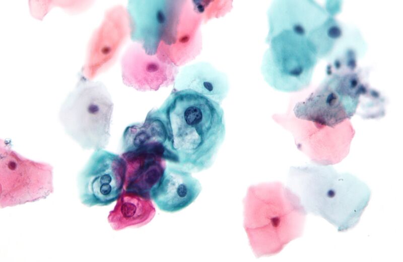File:Low grade squamous intraepithelial lesion.jpg