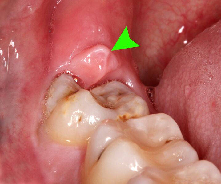 File:48 clinical pericornitis.jpg