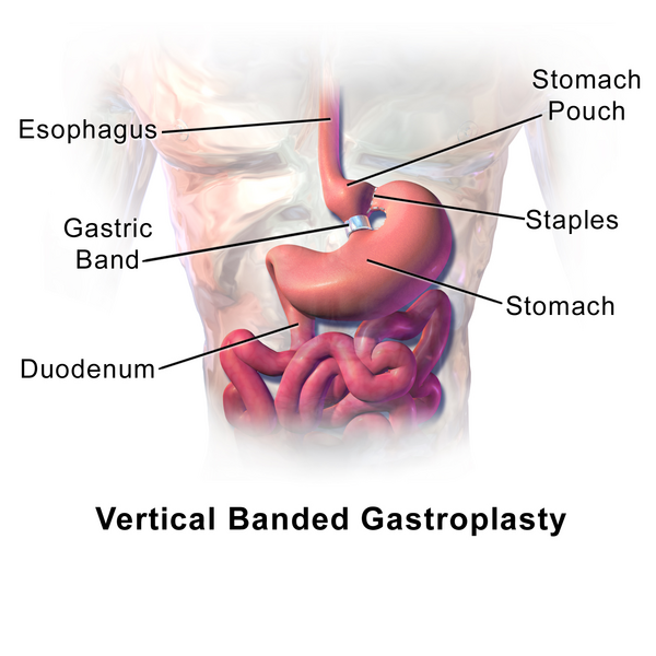 File:Blausen 0904 VerticalBandedGastroplasty.png