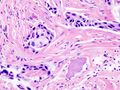 Invasive carcinoma of no special type