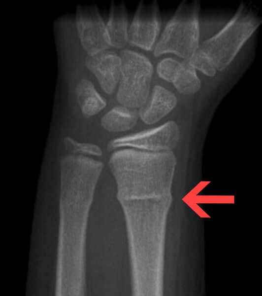 File:Buckle Fracture.jpg