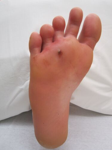 File:Footpuncture.JPG