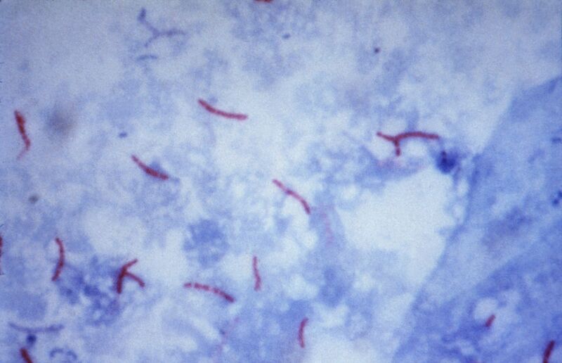 File:Mycobacterium tuberculosis Ziehl-Neelsen stain 02.jpg
