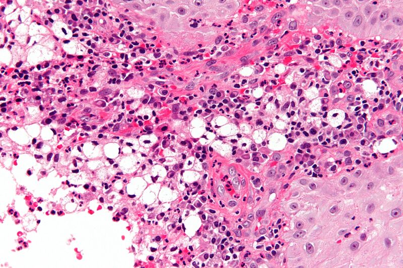 File:Rhinoscleroma - very high mag.jpg