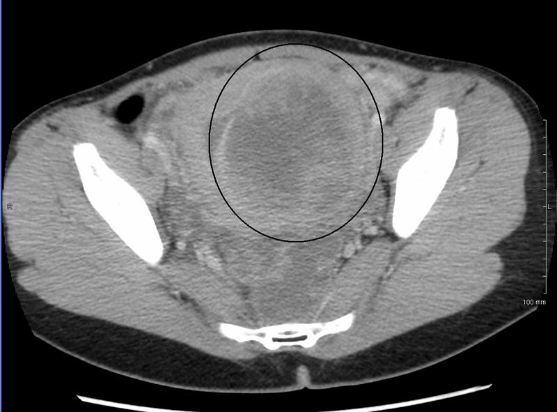 File:9cmFibroidPelvicCongestionS.png