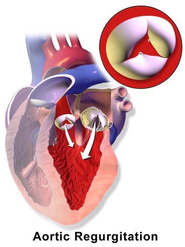 File:Blausen 0039 AorticRegurgitation.png