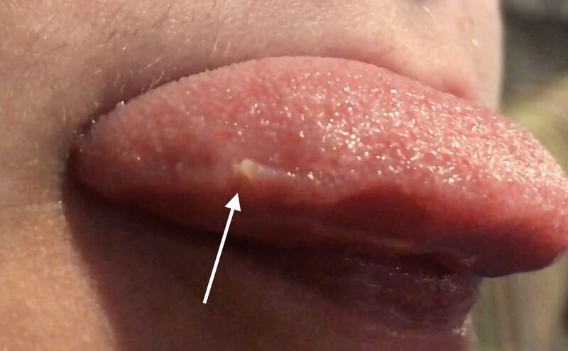 File:Transient lingual papillitis annotated.jpg