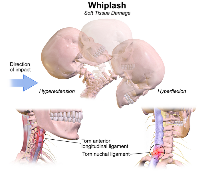File:Whiplash.png