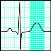 File:Tnorm (ECG).svg