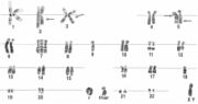 Human karyotype from bladder carcinoma, including ring chromosome