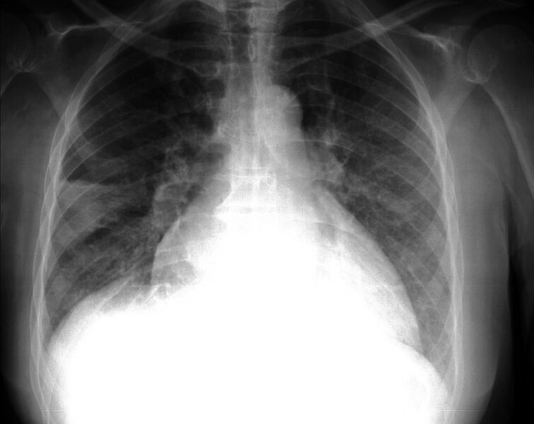 File:Pulmonary infarction, right lung 1.jpg