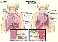 Pleurisy and pneumothorax