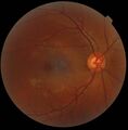 Retinography image