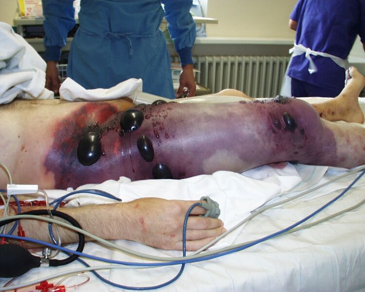 File:Gas gangrene.jpg