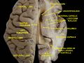 Occipital lobe