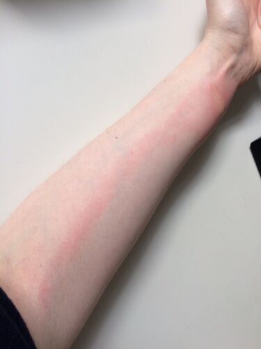 File:Lymphangitis after bed bug bites.jpg