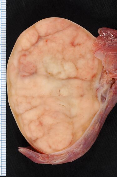File:Seminoma of the Testis.jpg