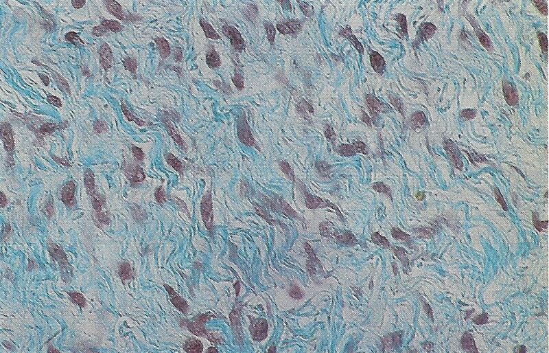 File:Fasciitis nodularis (Goldner).jpg