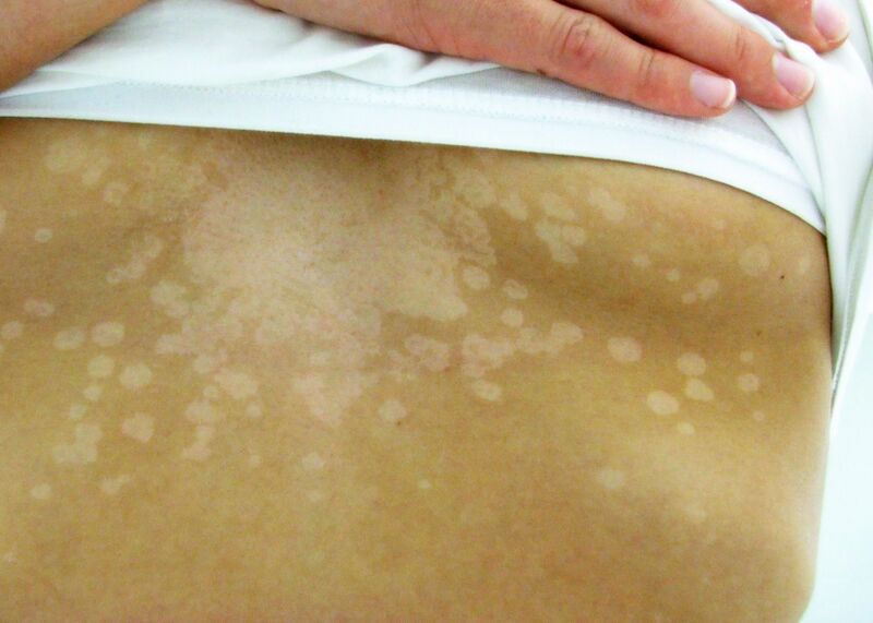 File:Tinea versicolor1.jpg