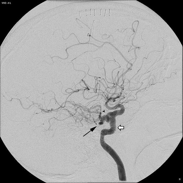 File:Persistent trigeminal.JPG