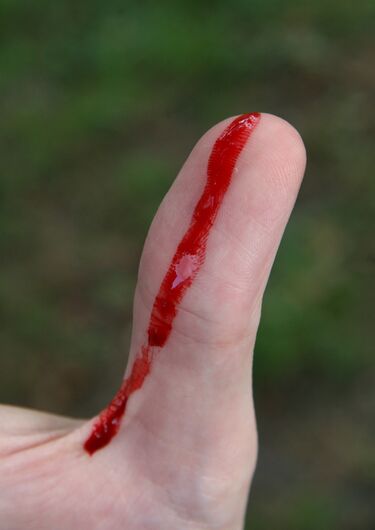 File:Bleeding wound on thumb.jpg