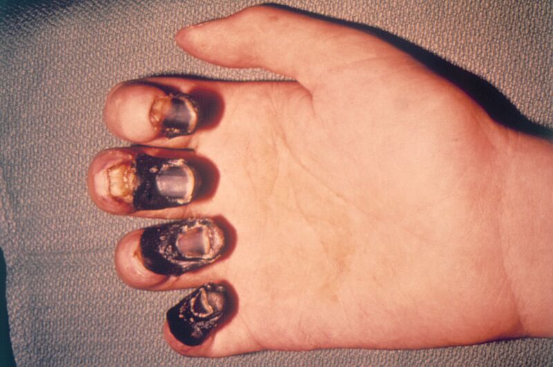 File:Acral gangrene due to plague.jpg