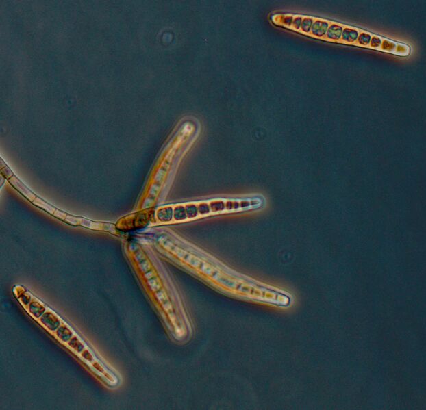 File:Dpk-meningitis-exserohilum2.jpg