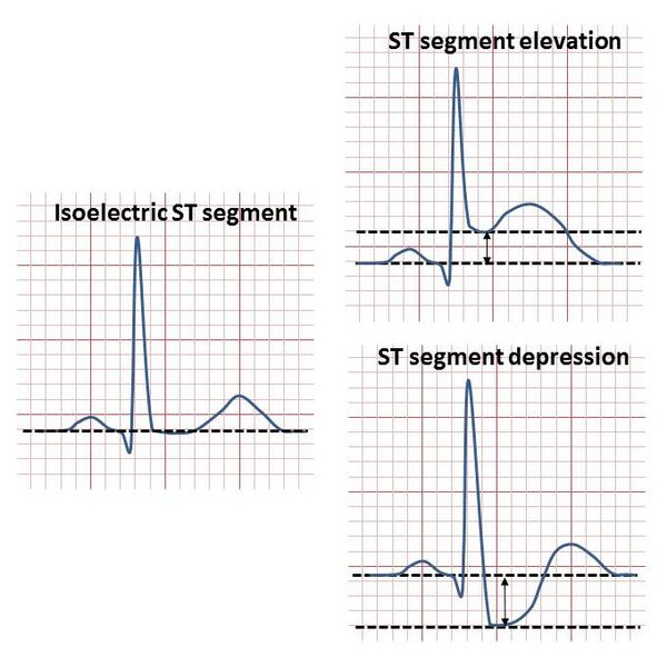 File:ST segment elevation and depression.jpg