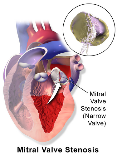 File:Blausen 0648 MitralValveStenosis.png