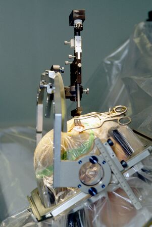 Placement of an electrode into the brain for deep brain stimulation