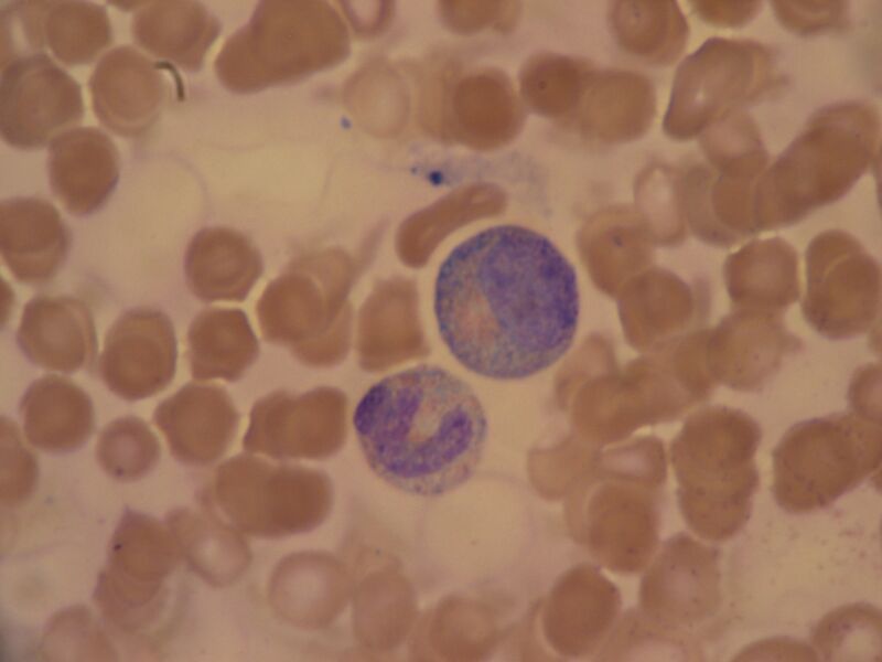 File:Toxic granulation.JPG