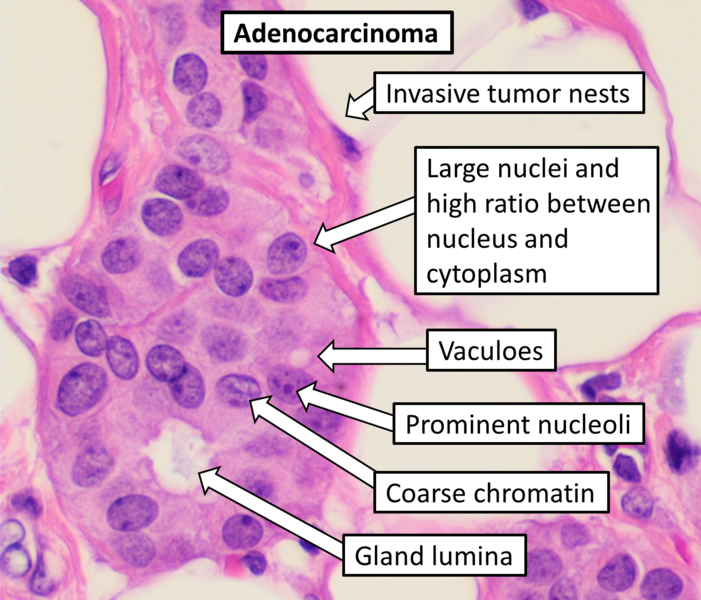 File:Histopathology of adenocarcinoma.png