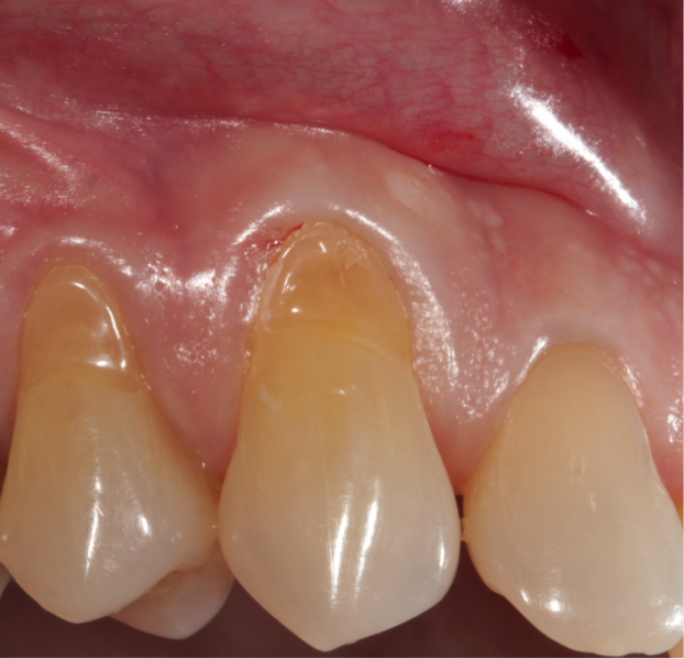 File:Gum graft fig 1.png