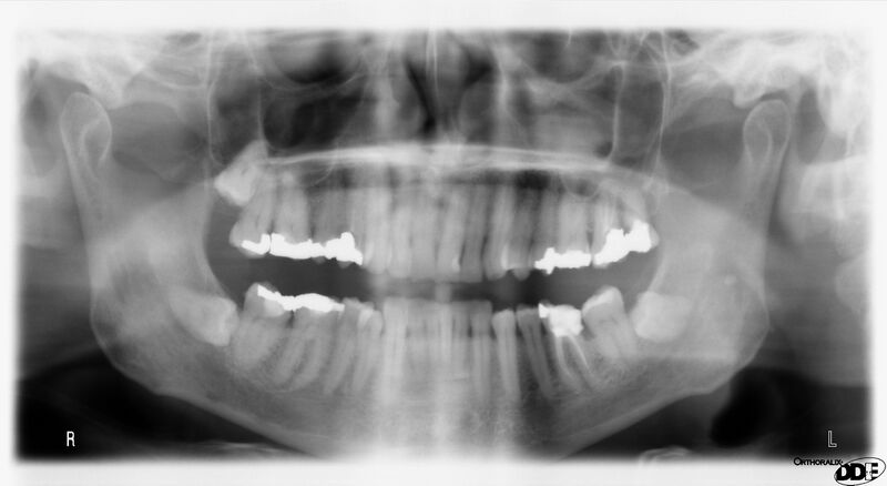 File:PAN TEETH.jpg