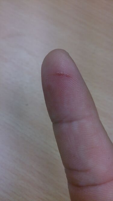 File:Finger cut.jpg