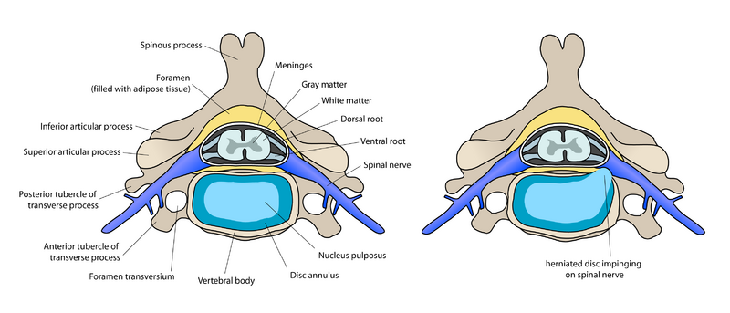 File:ACDF coronal english.png