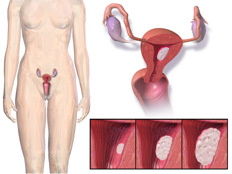 File:Blausen 0348 EndometrialCancer.png