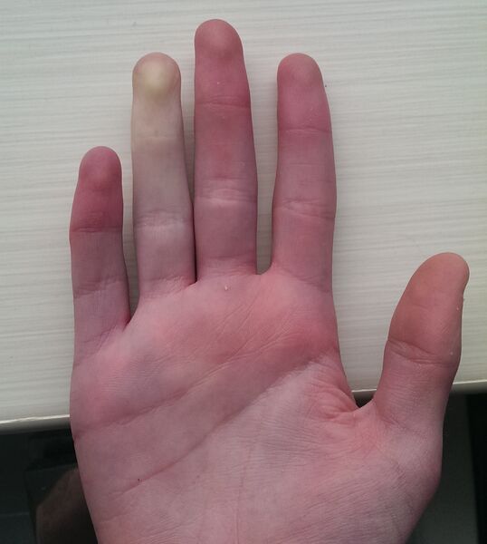 File:Raynaud's Phenomenon (front).jpg
