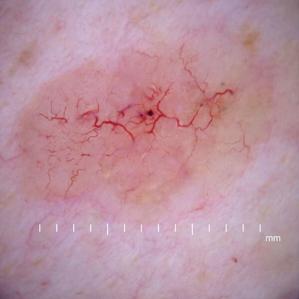 File:Dermoscopy nodular basal cell carcinoma.jpg