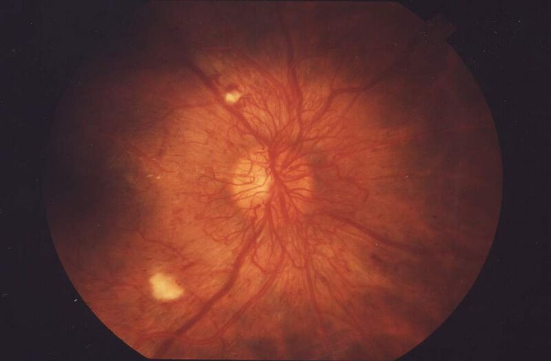 File:Fundus Proliferative retinopathy EDA01.JPG