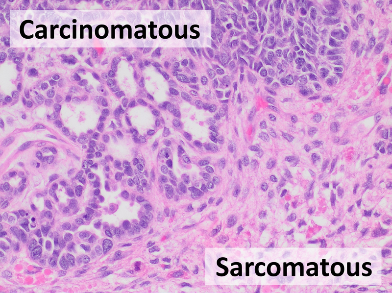 File:Histopathology of carcinosarcoma, annotated.png