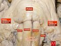 Medulla oblongata, pons, and middle cerebellar peduncle