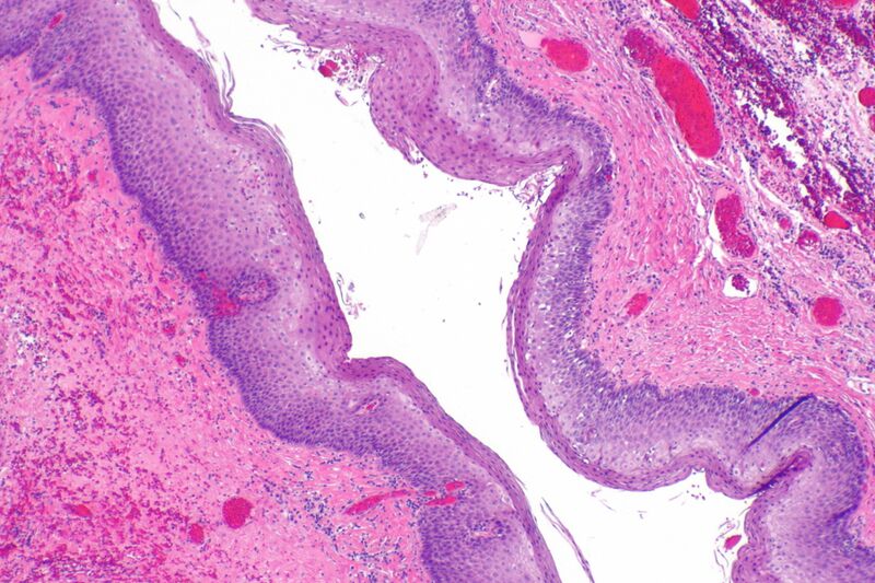 File:Pharyngoesophageal diverticulum -- low mag.jpg