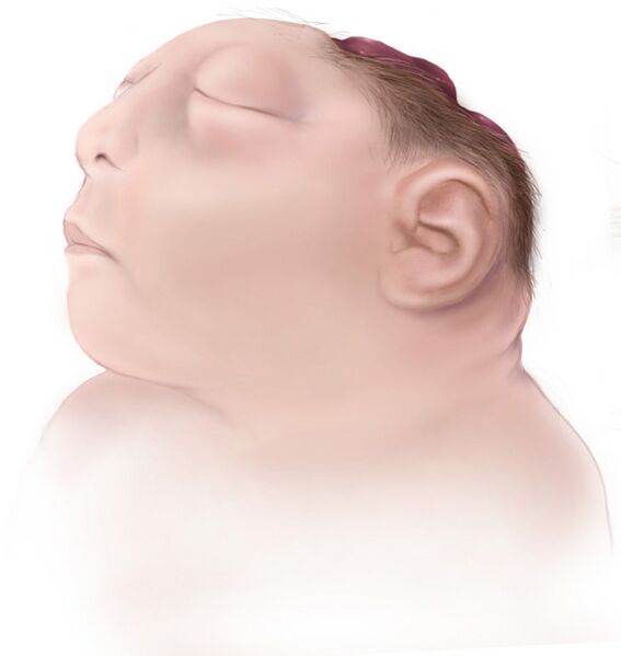 File:Anencephaly-web.jpg