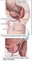 Radical perineal prostatectomy