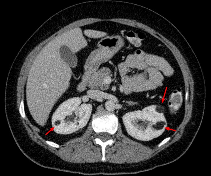 File:Angiomyolipome der Niere CT.jpg